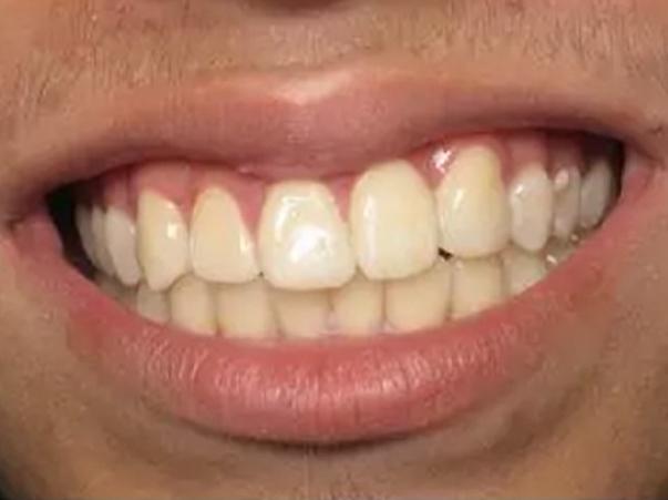 Caso 1 — después del tratamiento Invisalign