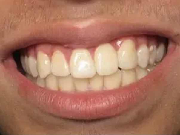Caso 1 — después del tratamiento Invisalign