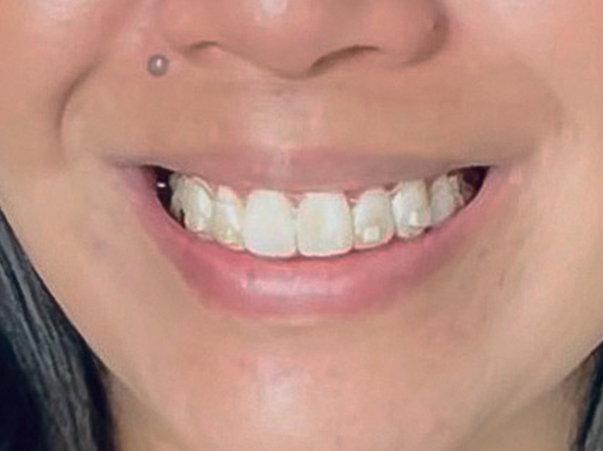 Caso 2 — después del tratamiento Invisalign